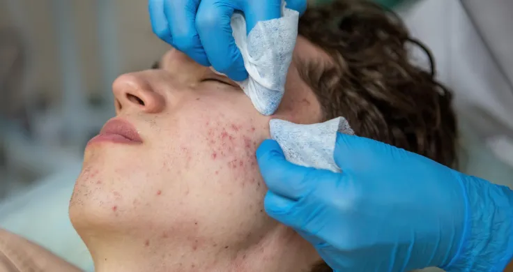 Pimple scar removal in Porur